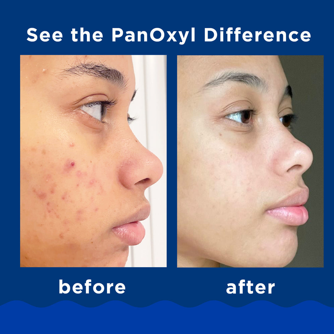 PanOxyl Acne Foaming Wash 10%