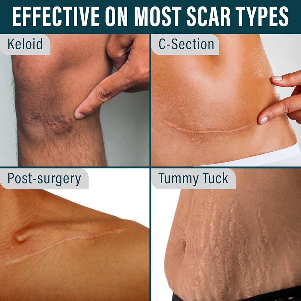 Silicone Scar Tape for Surgical Scars
