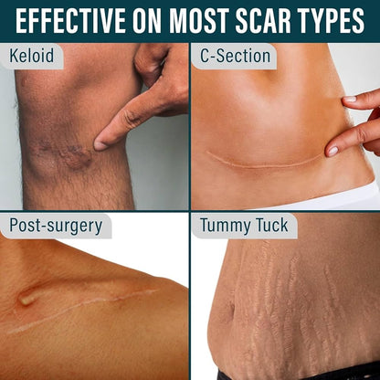 Silicone Scar Tape for Surgical Scars