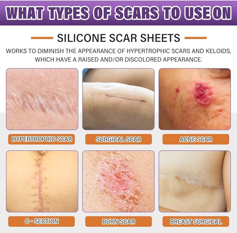 Silicone Scar Tape for Surgical Scars
